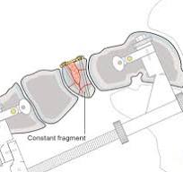ORIF - Navicular plate for Complete articular navicular fracture