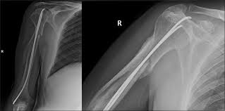 Not only is the place extremely clean but their dip powder. Elastic Stable Intramedullary Nailing As A Treatment Option For Comminuted Proximal Humeral Shaft Fractures In Adults A Report Of Two Cases And A Review Of The Literature Alshammari An Altayeb Ma Alnazer