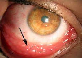 Image result for Gonococcal Conjunctivitis