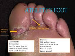 Athlete S Foot