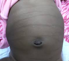 Learn how to gain relief from acid reflux with this all natural time tested program! Transient Pigmentary Lines Of The Newborn Pediatrics