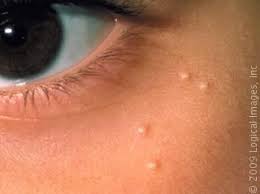 How do you get rid of pimples in an hour? How To Get Rid Of Hard White Spots On The Face Blog Health And Beauty Tips Skin Care Beauty Care