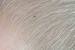 Lice In Blonde Hair