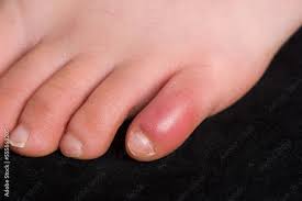 Image result for Chilblains