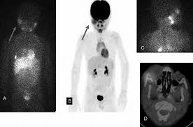 It most frequently starts from one of the adrenal glands but can also develop in the neck, chest, abdomen, or spine. A 3 Year Old Boy With Stage 4 Neuroblastoma 123 I Mibg Anterior And Download Scientific Diagram
