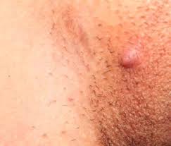 An ingrown hair is a very common skin condition occurring primarily after puberty. Ingrown Facial Hair Guide Causes Do S Don Ts Beard Style