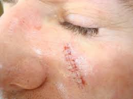 You have had a skin lesion removal. Wound Healing And Complications Dermatology Specialists