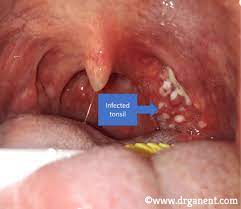 Should I Have My Tonsils Removed Dr Gan Eng Cern