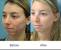 Laser Acne Scar Removal Cost