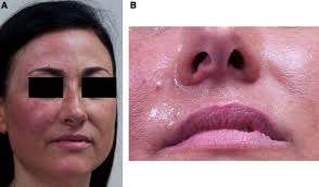 Physical and Psychological Consequences of Left Cardiac Sympathetic  Denervation in Long-QT Syndrome and Catecholaminergic Polymorphic  Ventricular Tachycardia