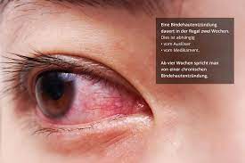 Virale bindehautentzündung steht die konjunktivitis in zusammenhang mit einem viral en infekt der atemwege ( grippaler infekt ), kann künstliche tränen flüssigkeit eingesetzt werden. Wie Lange Dauert Eine Bindehautentzundung