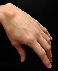 M31 should not be used for reimbursement purposes as there are multiple codes below it that contain a greater level of detail. Ganglion Cyst Wikipedia