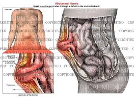 The front of the body is at right. Abdominal Hernia Anatomy Of Female Medical Art Works