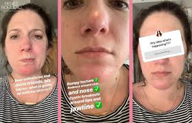 Image result for red rash face