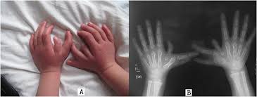 Image result for Supernumerary Digit