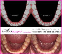 Sie schenken unseren patienten idealerweise ein leben lang ein strahlendes lächeln. Aligner Osnabruck Transparente Zahnschienen Fur Erwachsene 19 Photos Health Beauty Am Landgericht 2 49074 Osnabruck Germany