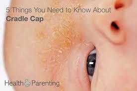 Image result for Cradle Cap