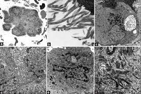 Primary malignant mesothelioma of the tunica vaginalis of the testis. Guidelines For Cytopathologic Diagnosis Of Epithelioid And Mixed Type Malignant Mesothelioma Complementary Statement From The International Mesothelioma Interest Group Also Endorsed By The International Academy Of Cytology And The Papanicolaou Society Of