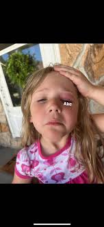 Tongue and lip revision for older children?