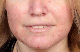 Beträffande infektion än någon annan parasitangrepp och infektion och omedelbart gör sig gällande hudutslag ansikte. Rosacea Roda Utslag I Ansiktet Orsak Behandling