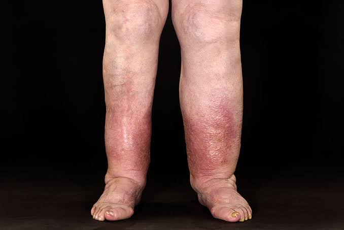 Causes & Treatment &ndash; Lymphoedema / Oedema of Legs & Feet