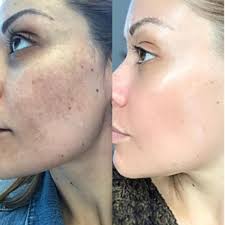 How Cosmelan Treats Pigmentation | Dermanude Altrincham