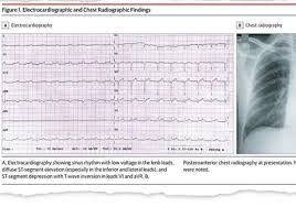 It can present as an acute, subacute, or chronic disease process and may present with either focal or diffuse involvement of the myocardium. Attacco Cardiaco E Coronavirus In Alcuni Casi Colpisce Il Cuore Corriere It