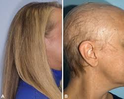 There are also other causes of hair loss. Chemotherapy Induced Alopecia Sciencedirect