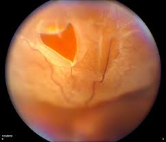 How is a detached retina treated? Retinal Tears And Detachment Northern Eye Centre