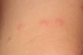 See our tips on how to identify bed bugs from the timing and pattern of your bites or skin rash. Bedbugs Arthropod Reaction Dermatology Advisor