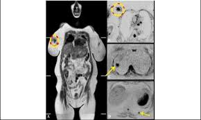 Breast mri is probably the most sensitive test we currently have available for the detection of breast cancer. The Previous Case Of Metastatic Breast Cancer A Wb Mri Coronal T1w Download Scientific Diagram