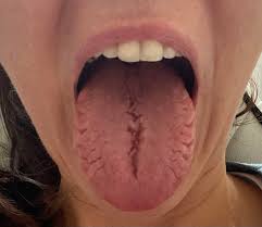 Image result for Fissured tongue