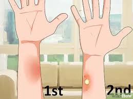 1st, 2nd, 3rd and 4th degree burns explained along with presentation and pathology. How To Stop The Burning In First Degree Burns Temporarily 9 Steps