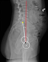 It is performed to look for evidence of injury (or pathology) affecting. Pelvic Evaluation In Thoracolumbar Corrective Spine Surgery How I Do It Radiology