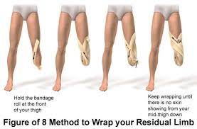 Below The Knee Amputation Discharge Care Care Guide Below The Knee Amputation Orthotics And Prosthetics Prosthetic Leg