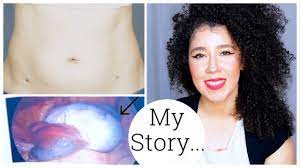I M Back My Ovarian Cyst Story Ovarian Torsion Laparoscopy Surgery Youtube