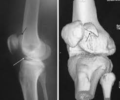 We did not find results for: Displaced Osteochondral Fracture Of The Lateral Femoral Condyle Associated With An Acute Anterior Cruciate Ligament Avulsion Fracture A Corollary Of The Lateral Femoral Notch Sign Springerlink