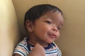 Smyrna newborn recovering after surgery for skull problems