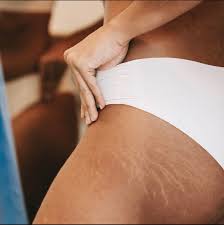 Stretch marks and what can we do about them?