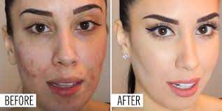 The 17 Best Foundations That Actually Help Your Acne Best Foundation For Acne Best Makeup For Acne Foundation Acne Prone Skin