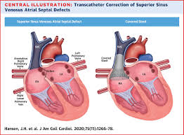 Image result for Atrial Septal Defect