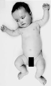 Achondroplasia Pediatrics Orthobullets