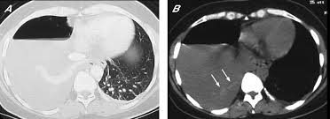 Radiology department of the vu university medical the ct and mr characteristics of abdominal wall endometriosis are nonspecific, both showing a solid enhancing mass in the abdominal wall. Mri Features Of Pleural Endometriosis After Catamenial Haemothorax Thorax