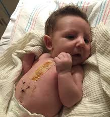 At 23 days old, he had open-heart surgery
