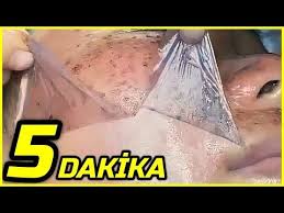 5 Dakikada Leke Sokucu Cildi Yuzu Puruzsuz Kusursuz Porselen Gibi Yapan Maske Guzellik Bakim Youtube Dogal Akne Tedavisi Akne Tedavisi Cil