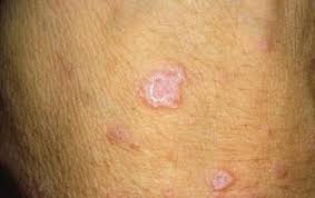 Image result for penis mycosis symptoms