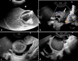 Image result for corpus luteum sonography)