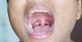 When not mineralized, the presence of debris is known as chronic caseous tonsillitis (cct). Do Tonsil Stones Cause Bad Breath Smartmouth