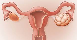 This can lead to problems with your ovaries, such as not having your. Polycystic Ovarian Syndrome Pcos