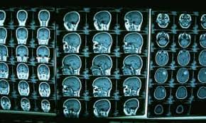 A ct scan allows for more insightful analyses than other imaging tests without the need for invasive over 70 million ct scans are performed in the united states each year, according to research from. Ct Scans Warning After Study Claims Too Many Could Lead To Brain Cancer Health The Guardian